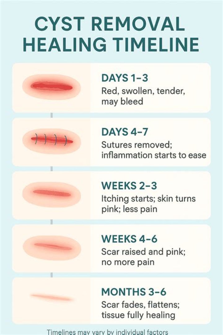 Are you put to sleep for cyst removal?