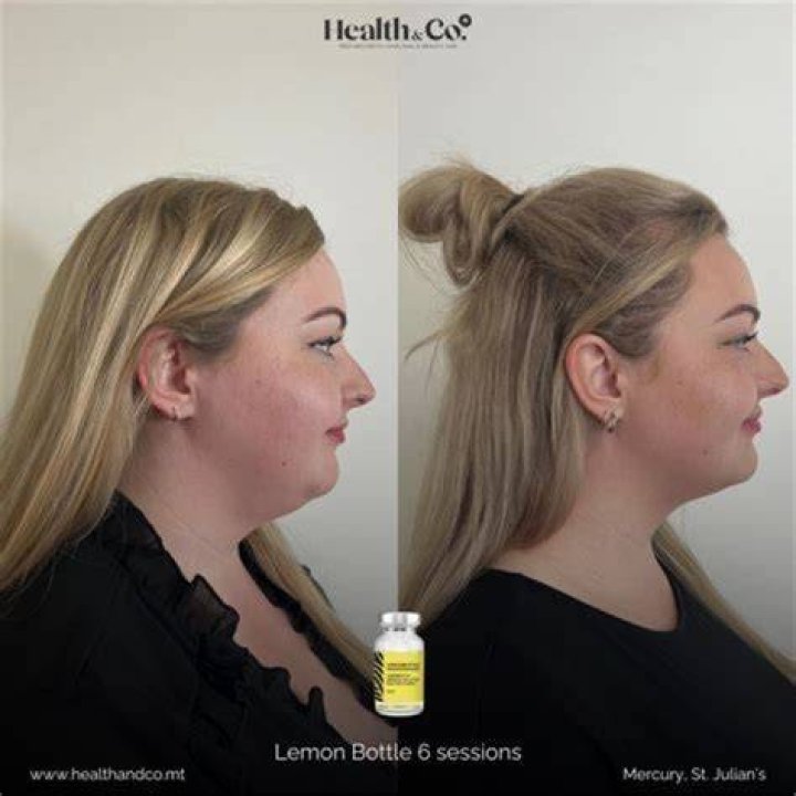 Can I apply lemon directly on face?