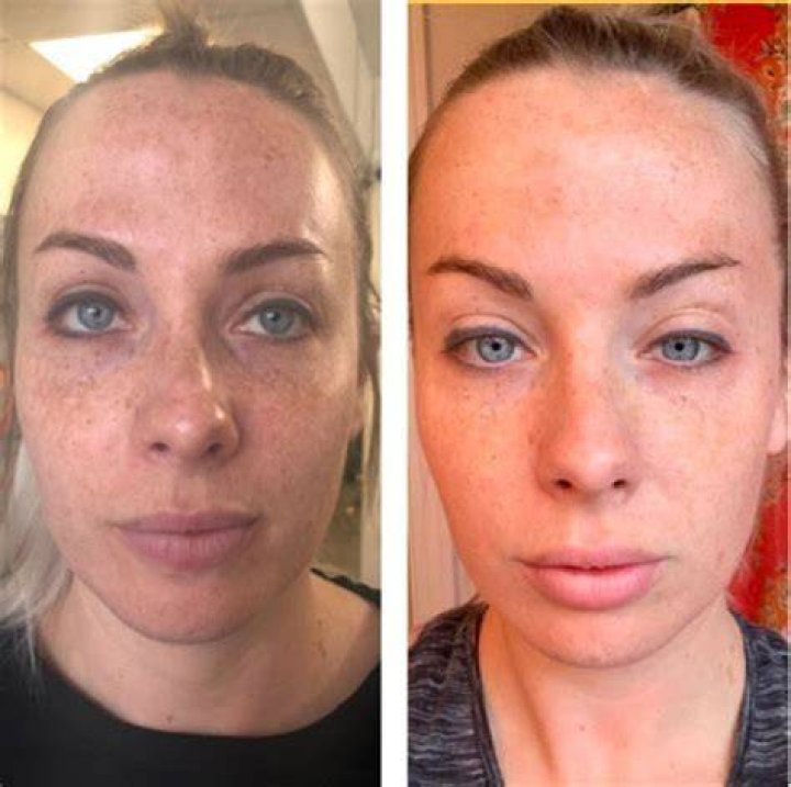 Can microneedling remove blackheads?