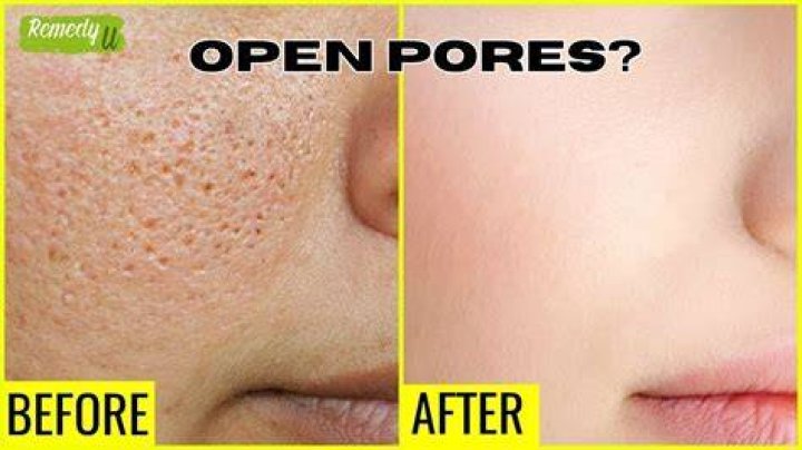 Can salt close open pores?