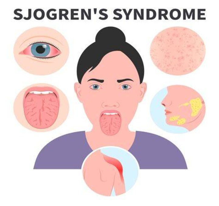 Can Sjogren's go into remission?