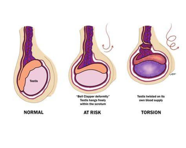 Can testicular torsion fix itself?