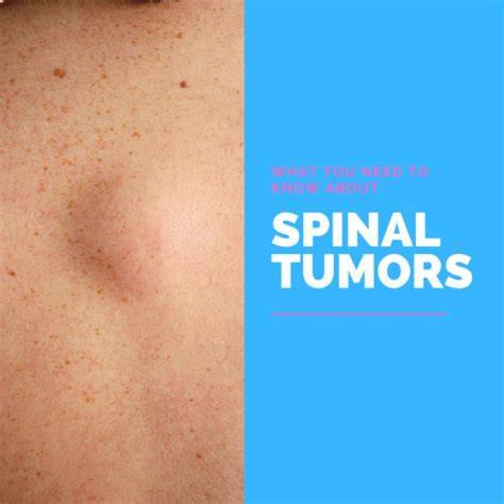 Can you feel a tumor on the back of your neck?