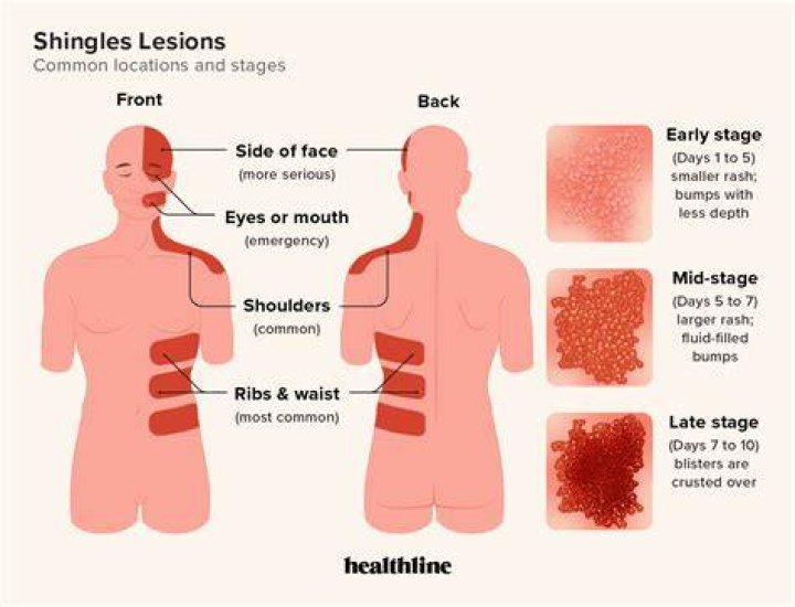 Can you get shingles three times?