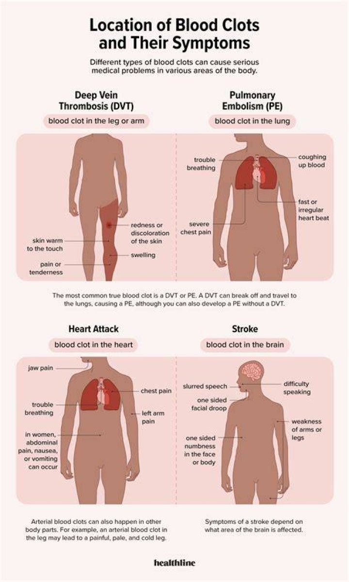 Can you have a blood clot and not know it?