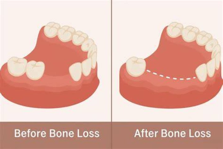 Can you have false teeth with bone loss?