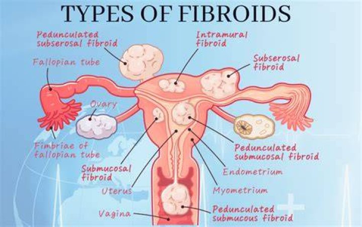 Can you live with fibroids?