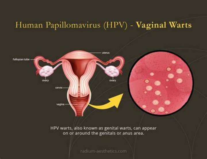Do I have HPV forever?