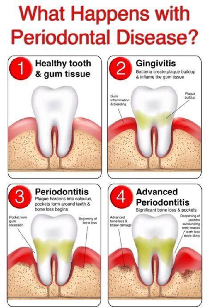 How can you tell the difference between periodontitis and gingivitis?