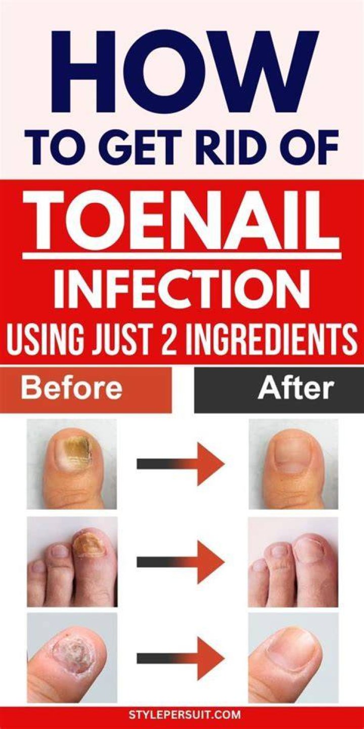 How do I get rid of brown toenails?