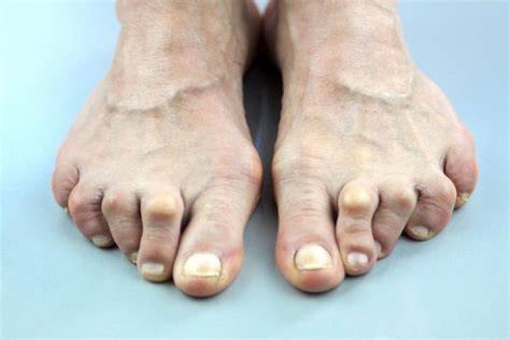 How do I know if I've got arthritis in my toes?