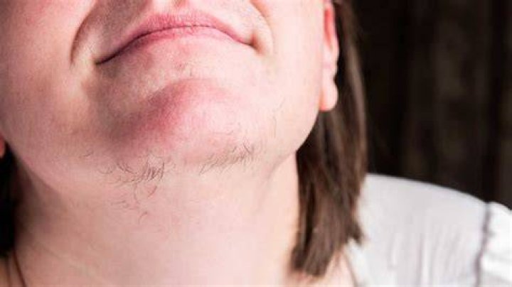 How do u get rid of chin hair?