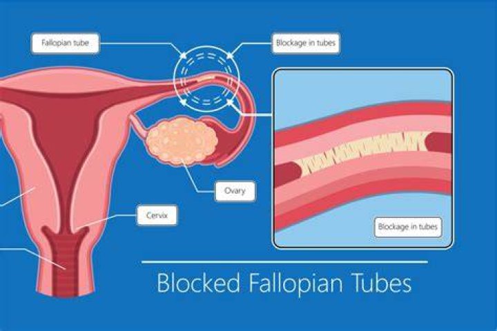 How do you know if you have blocked fallopian tubes?