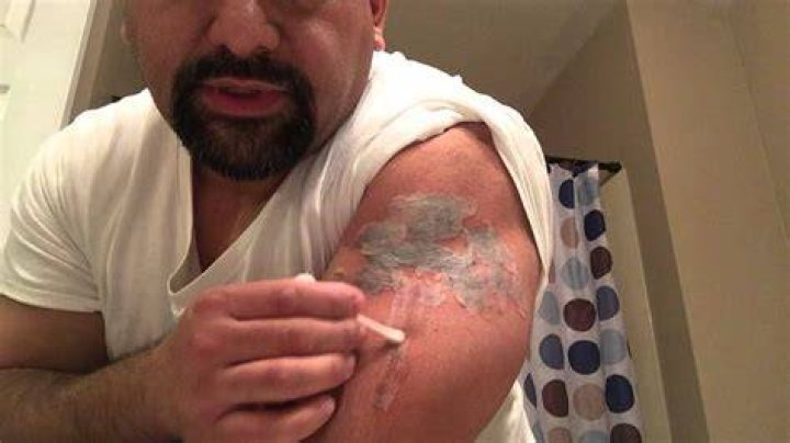 How do you remove a tattoo with salt?