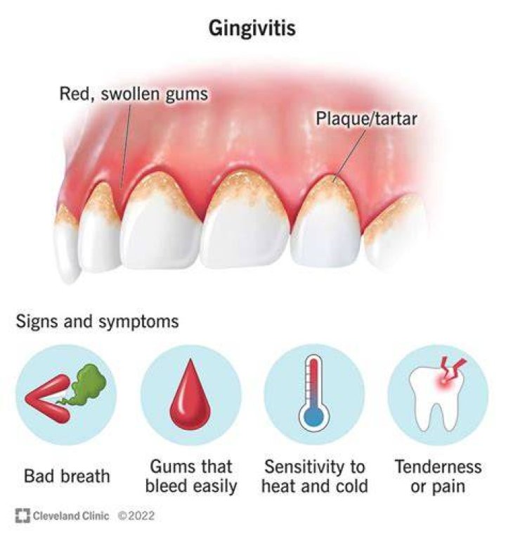 How I cured my gingivitis?