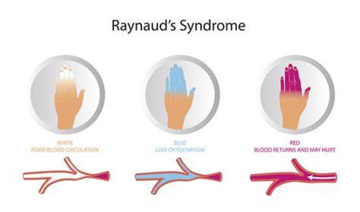 How is Raynaud's diagnosed?
