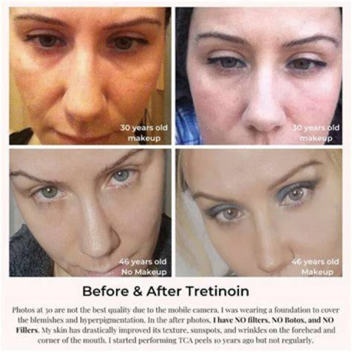 How long should you let tretinoin absorb?