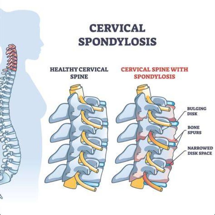 Is cervical spondylosis serious?