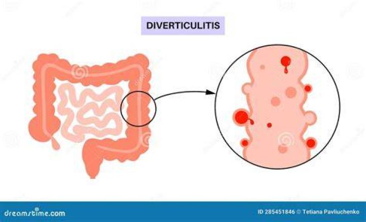 Is flatulence a symptom of diverticulosis?