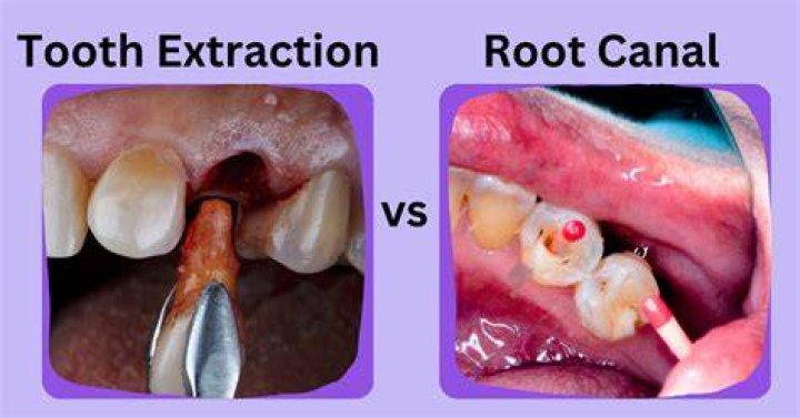 Is it better to get a root canal or pull the tooth?