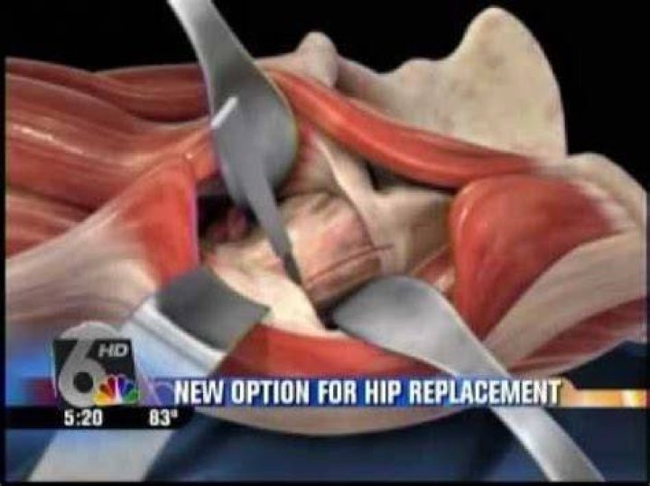 Is muscle cut during hip replacement?