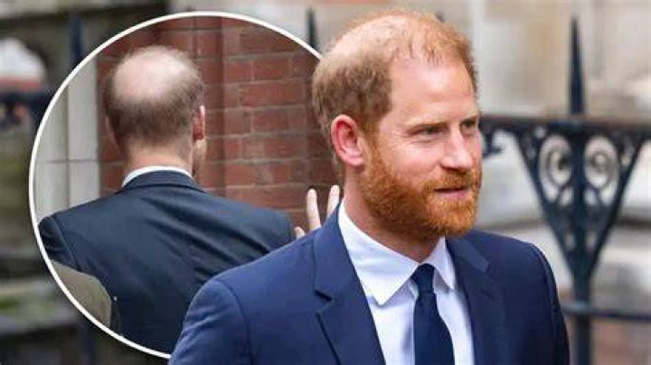 Is Prince Harry's hair thinning?