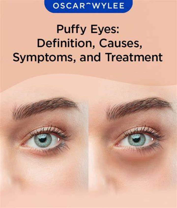 What are puffy eyes a symptom of?