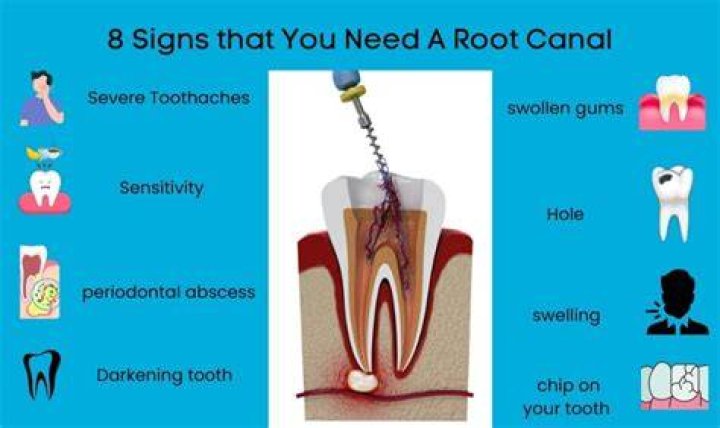 What are the signs you need a root canal?