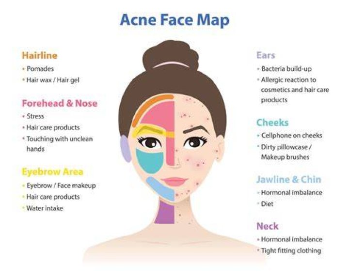 What causes acne on chin?