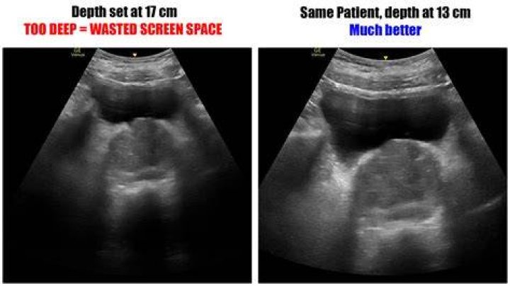 What is a deep ultrasound?