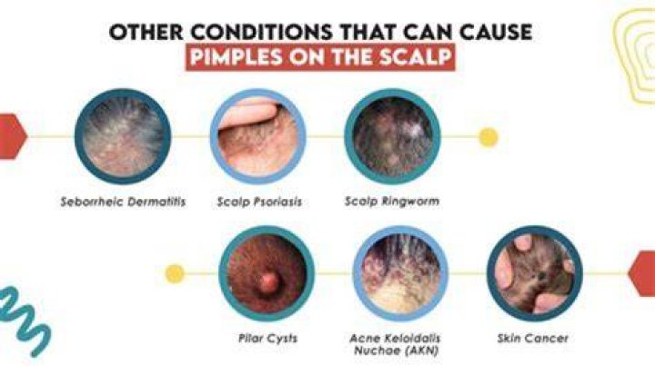 When I squeeze my pimple something hard comes out?