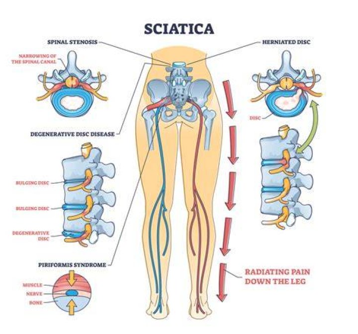 Where is sciatica pain felt?