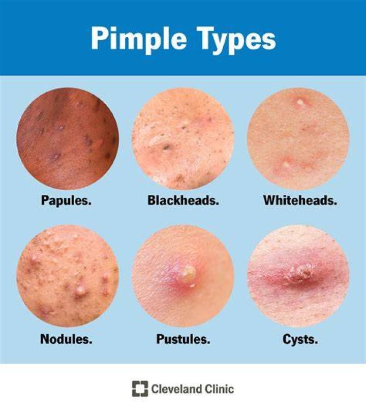 Why do old pimples smell?