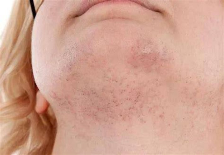Why is my chin hair so thick?